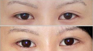 北京美莱整形医院双眼皮修复价格 杜圆圆技术高超