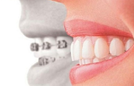乌鲁木齐美奥口腔门诊部牙齿矫正有几种方法 费用是多少