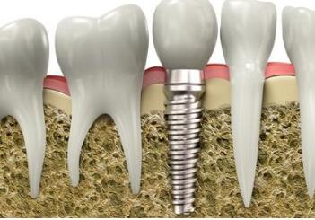 乌鲁木齐栽华口腔诊所种植牙齿过程 术后如何护理