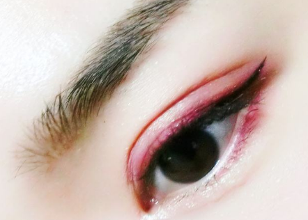 武汉伽美星美容整形韩式双眼皮与普通双眼皮有什么区别呢
