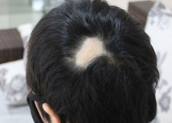 杭州维多利亚疤痕植发需要多少钱 植发不适合哪些人