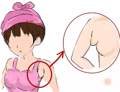 出现副乳怎么办 北京燕化医院做副乳切除手术的方法