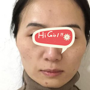 广州海峡整形医院<font color=red>热玛吉抗衰案例</font> 让您重新拥有少女感