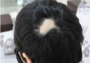 疤痕植发有用吗 上海雍禾植发前后对比图