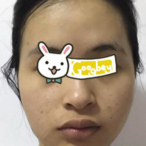  Suzhou Ruifushen Plastic Surgery Hospital Super Skin Second Acne Removing Print Case Helps You Find Your Baby's Muscle