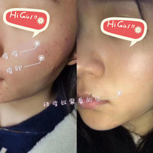  Tianjin Meilai Plastic Surgery Hospital Photorejuvenation and Acne Removing Print Case with Good Effect and No Trace