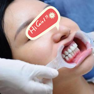 杭州植得口腔医院 牙齿美白贴面效果很不错
