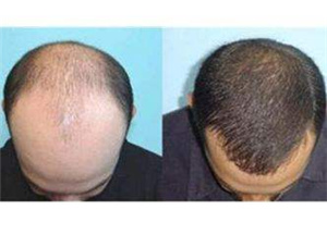 深圳植发医院排行 头发种植后大概多久能看到效果