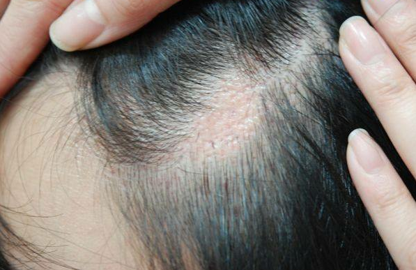 成都疤痕植发需要多少钱 成都科发源植发医院口碑如何