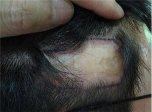 头上有疤痕可以植发吗 上海新极点疤痕植发前后效果图