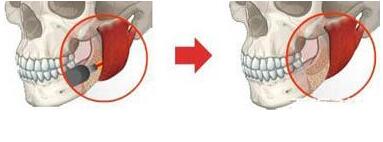 <font color=red>常州美贝尔</font>下颌角磨骨术如何操作 是不是安全的