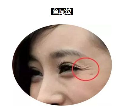北京东方百合手术去眼角鱼尾纹价格是多少 抵挡岁月的痕迹