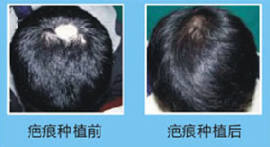 南京正规植发医院哪家好 哪些情况可以疤痕植发 价格贵吗