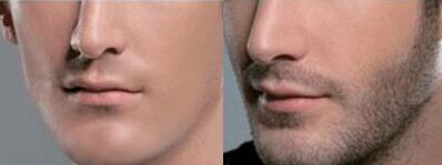 种植胡须的男人更自信 天津新发现植发医院怎么样