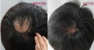 头部疤痕能植发吗 疤痕植发多久见效 需要多少钱