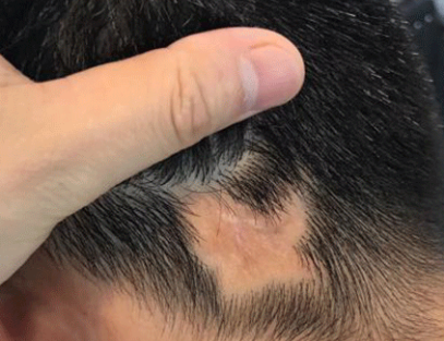 恢复自然美感 疤痕植发需要具备什么条件 术后多久见效