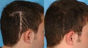 植发成功率高吗 疤痕植发的成活率怎么样 拯救脱发