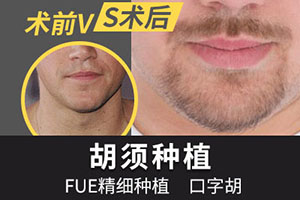 展现成熟男人味仅需三小时 天津友好植发胡须种植安全可靠