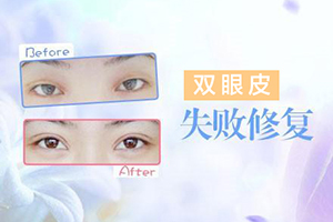 长沙爱馨双眼皮修复前后照片 手术难不难 要多少钱