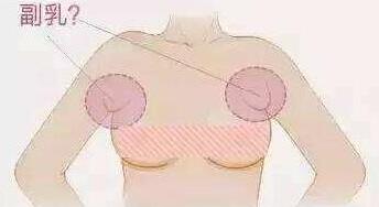 副乳怎么减 手术多少钱 苏州平江医院整形科副乳吸脂优缺点