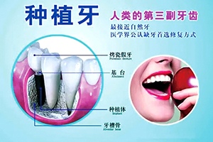 广州种植牙医院排名 德伦口腔门诊部上榜 种植牙多少钱一颗
