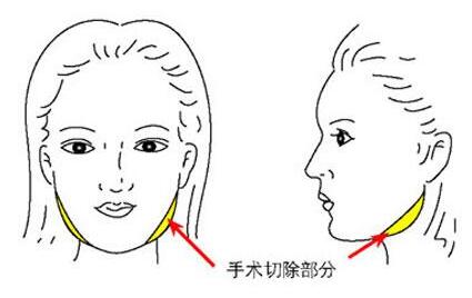 银川做下颌角整形需要多少钱  银川百思下颌角整形过程
