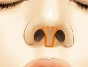 鼻小柱延长价格大概多少 杭州清锴整形医院鼻子整形对比图