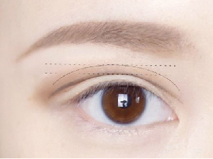 广州博美整形医院割双眼皮修复多少钱 修复手术成功率高吗