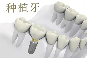 北京口腔医院整形科种植牙寿命多长 种植牙收费标准