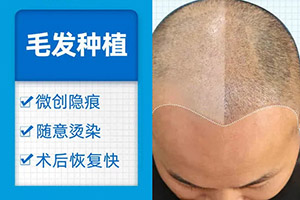 上海大麦微针头发种植多少钱 拥有浓密秀发的秘密