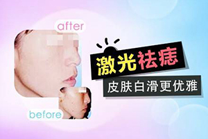  Jingjiang Laser Nevus Removal White Moonlight Medical Beauty Clinic is famous for removing facial spots