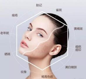  Lanzhou San'ai Medical Beauty Hospital Laser nevus removal process makes the skin smoother